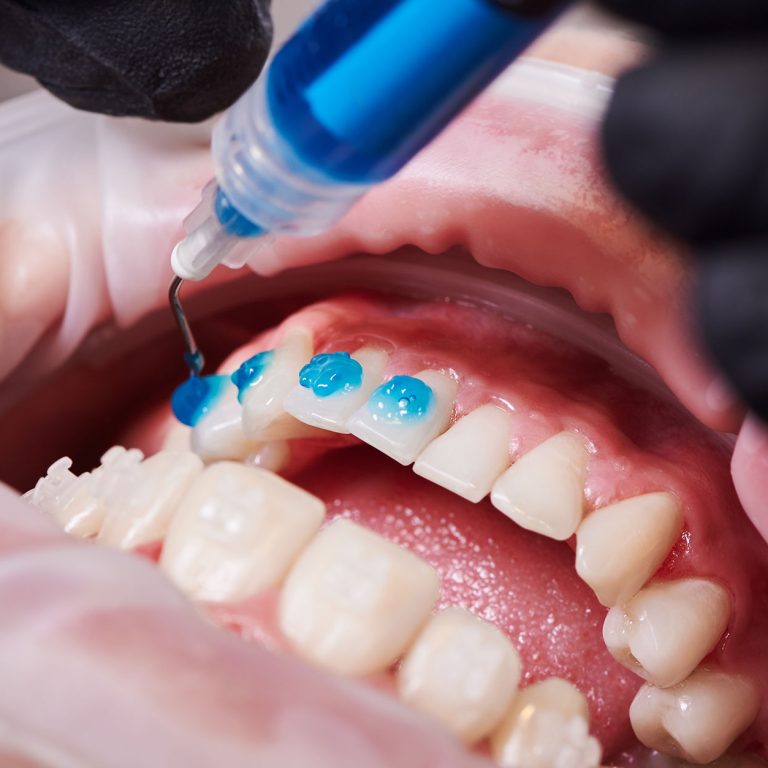 sbiancamento-dentale